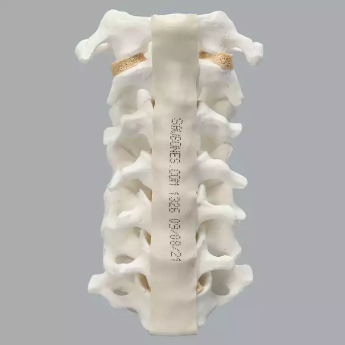 Spine, Cervical, Anterior and Posterior Ligaments, Solid Foam